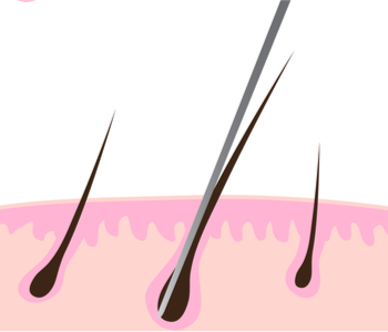 Needle inserted into hair shaft