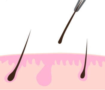 Hair is removed with tweezers