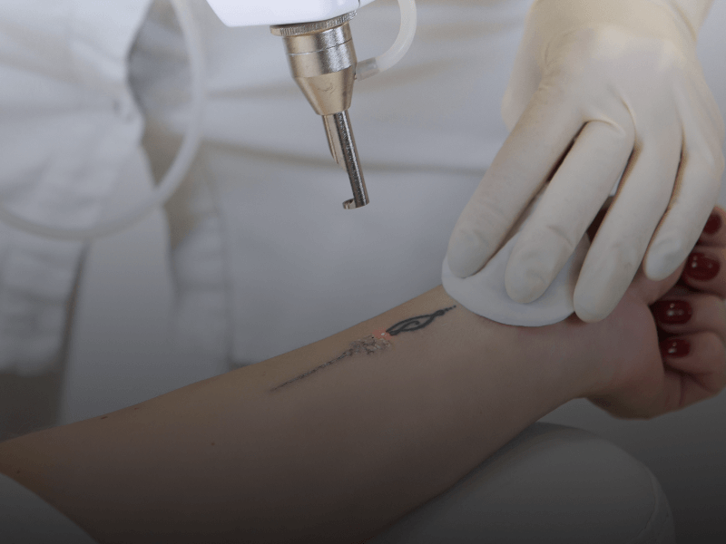 esthetician laser removing a tattoo